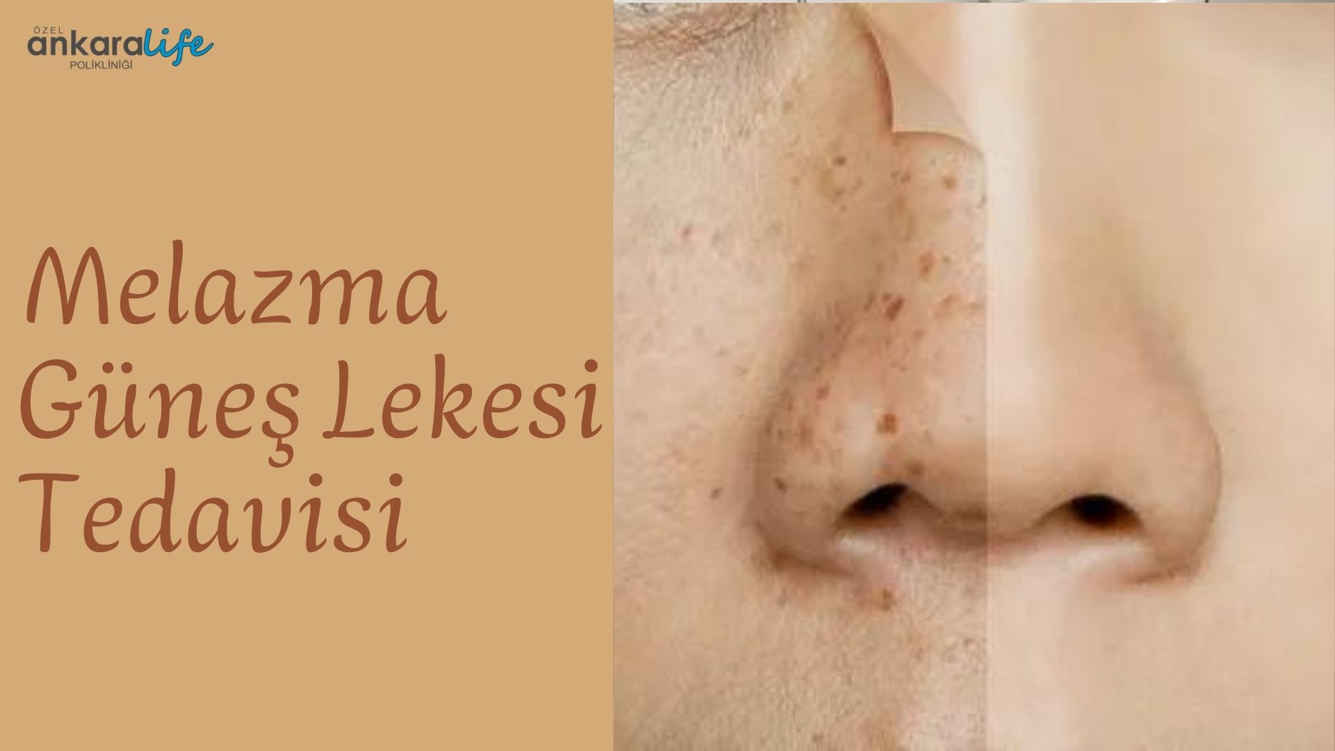 melazma-gunes-lekesi-tedavisi