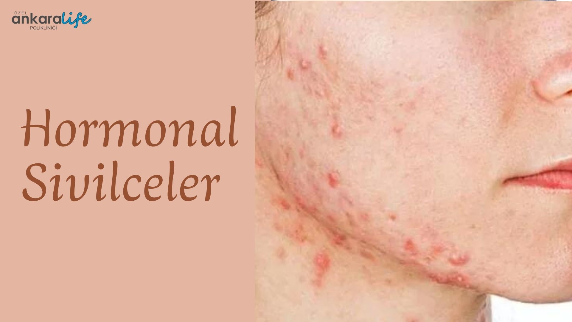 hormonal-sivilceler
