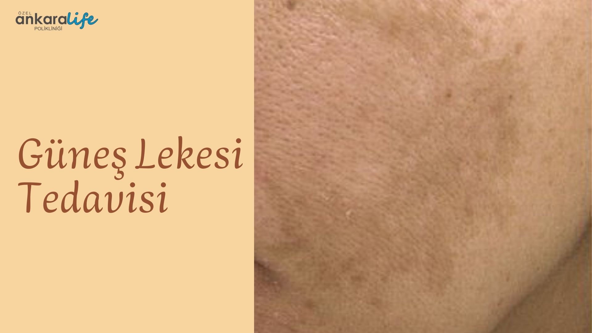 gunes-lekesi-tedavisi