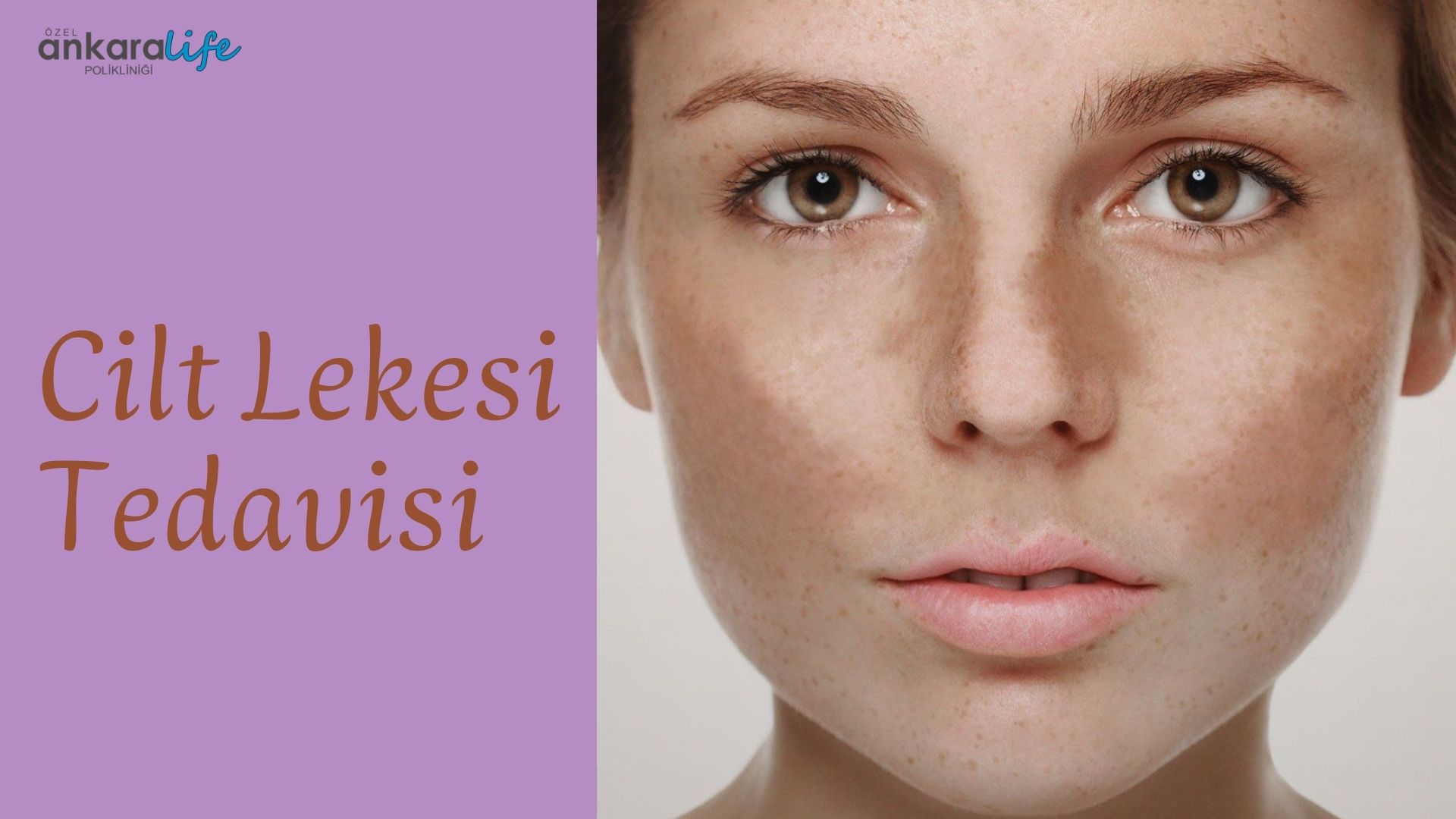 cilt-lekesi-tedavisi