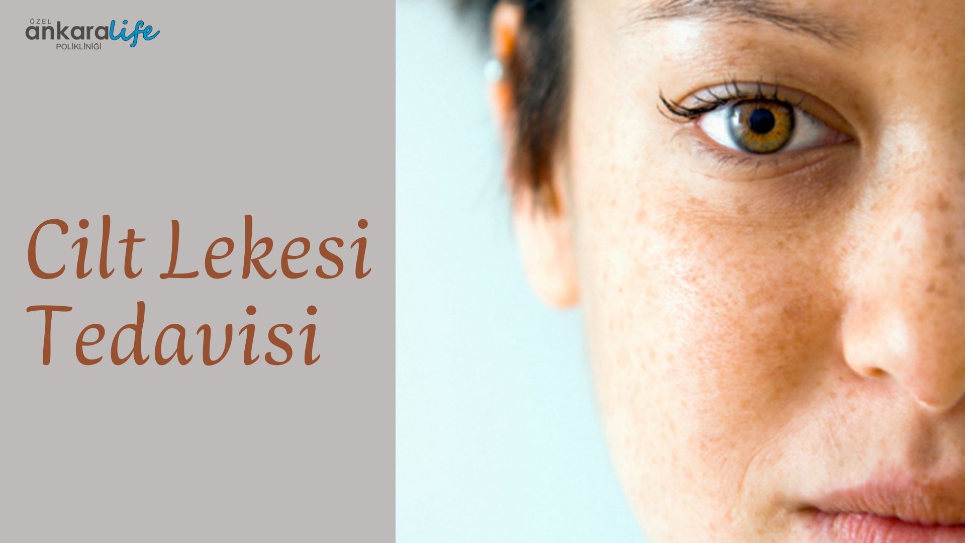 cilt-lekesi-tedavi