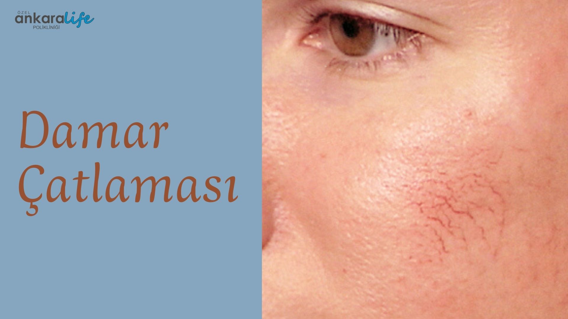 damar-catlamasi