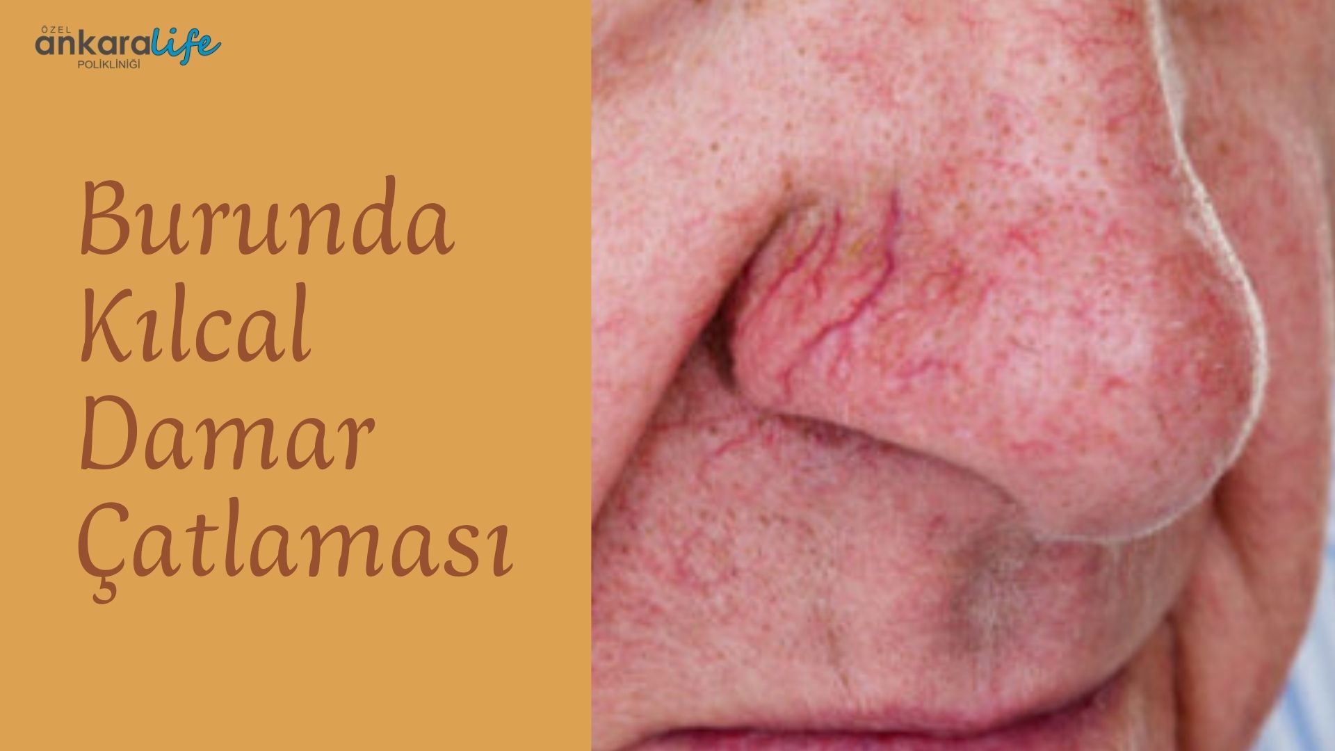burunda-kilcal-damar-catlamasi