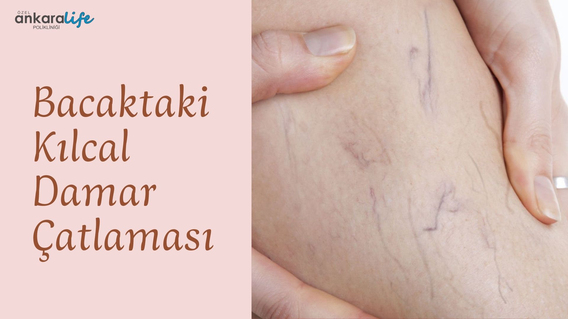 bacaktaki-kilcal-damar-çatlamasi