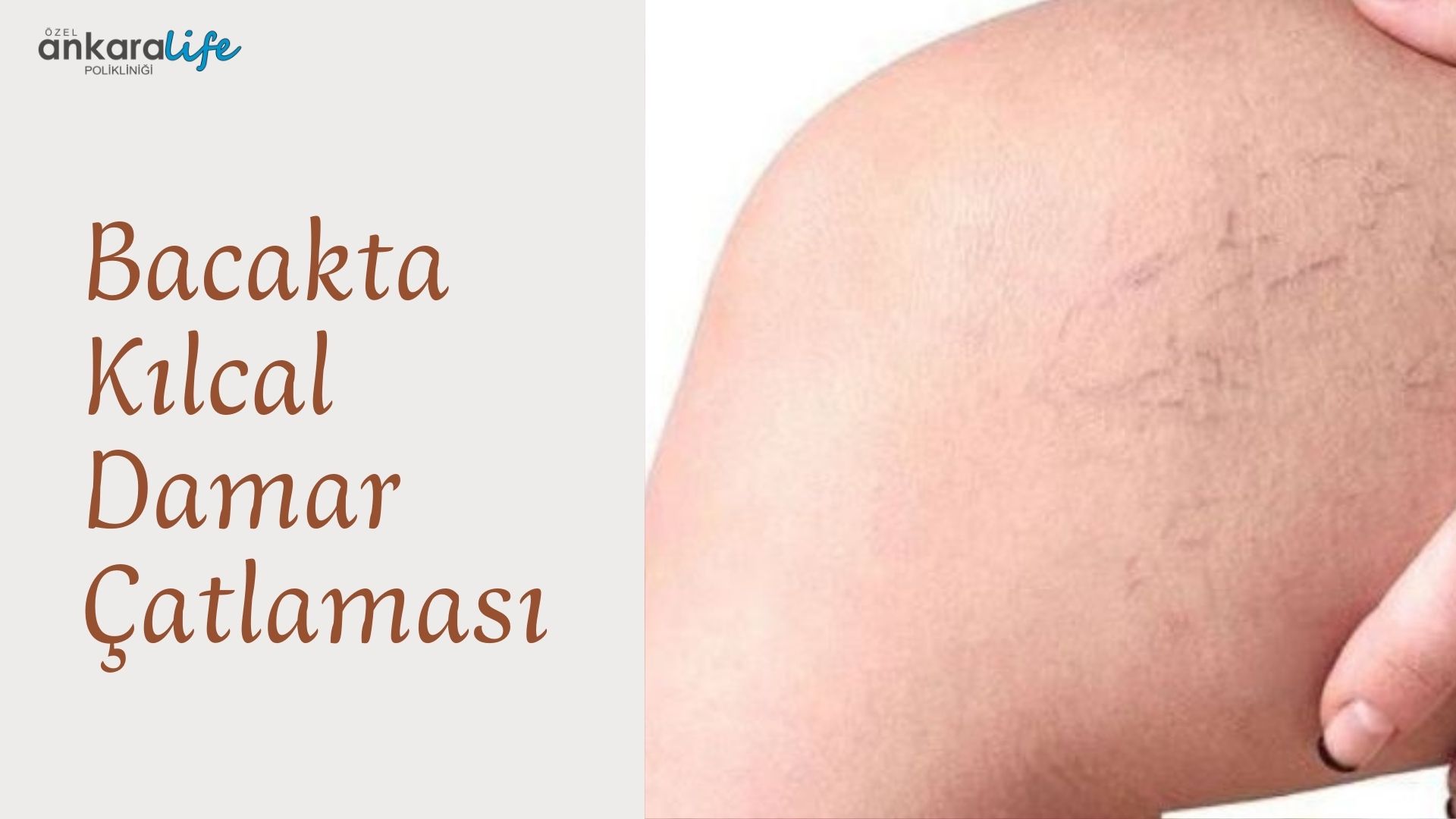 bacakta-kilcal-damar-çatlamasi
