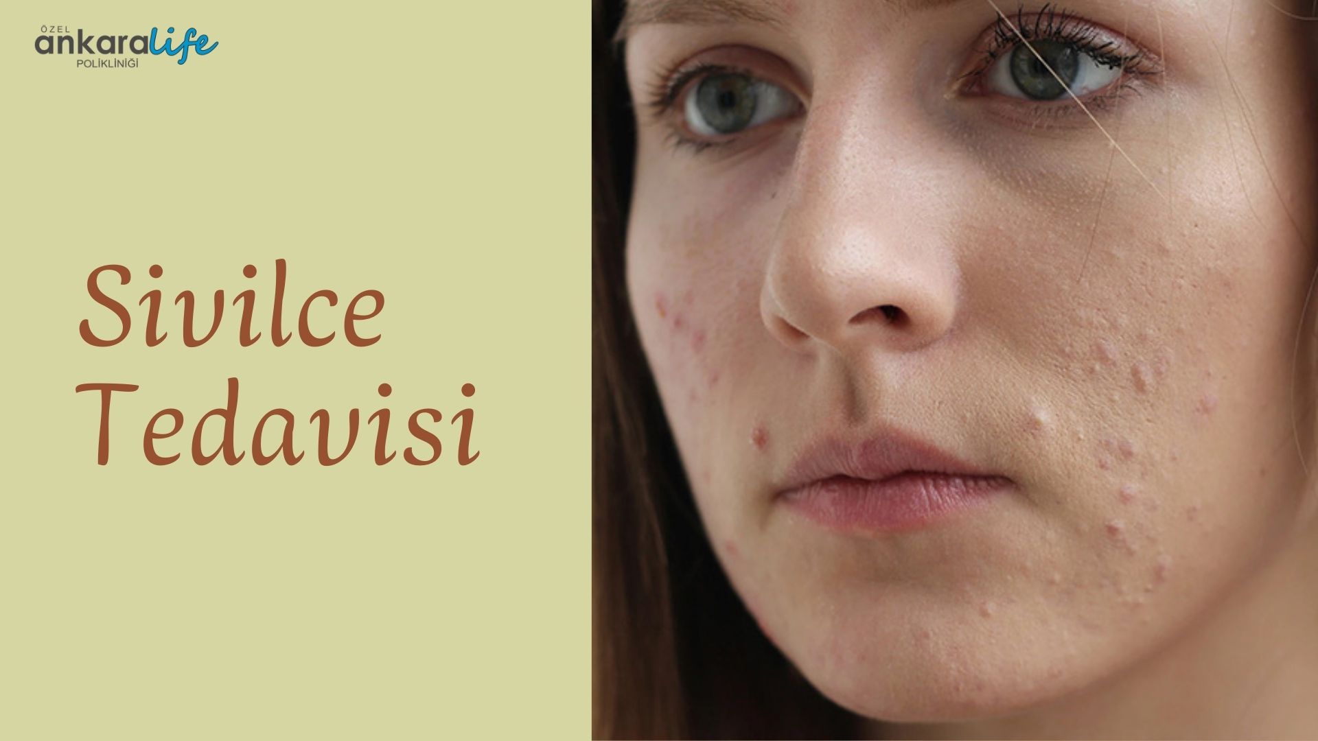 sivilce-tedavisi