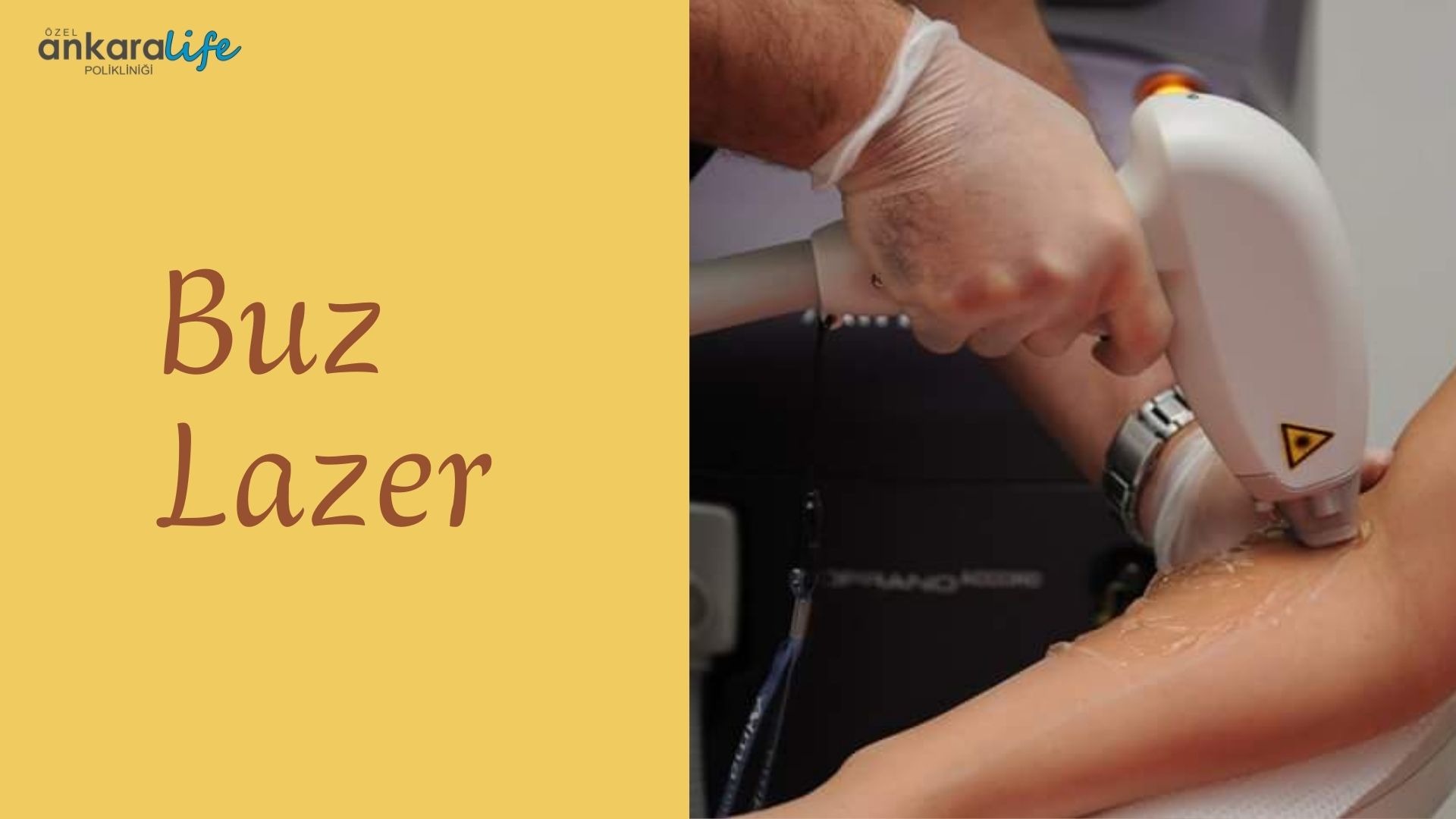 buz-lazer