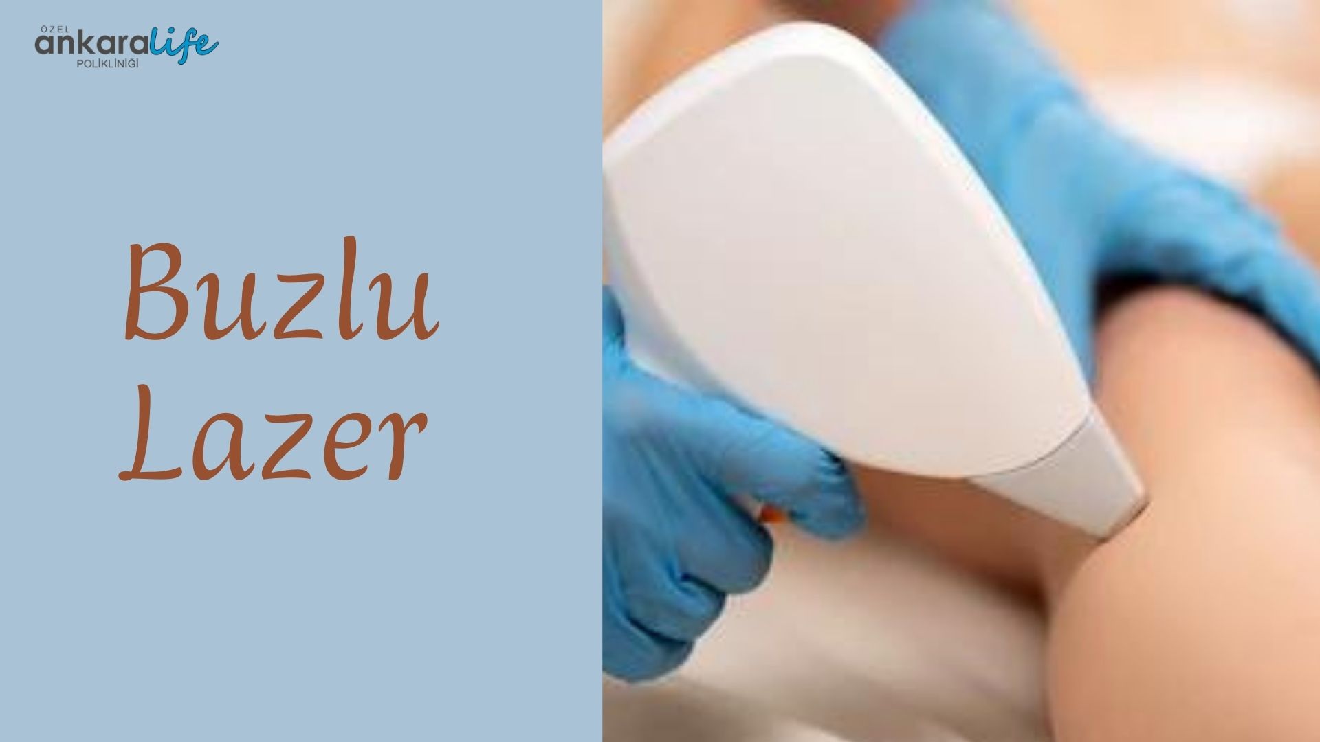buzlu-lazer