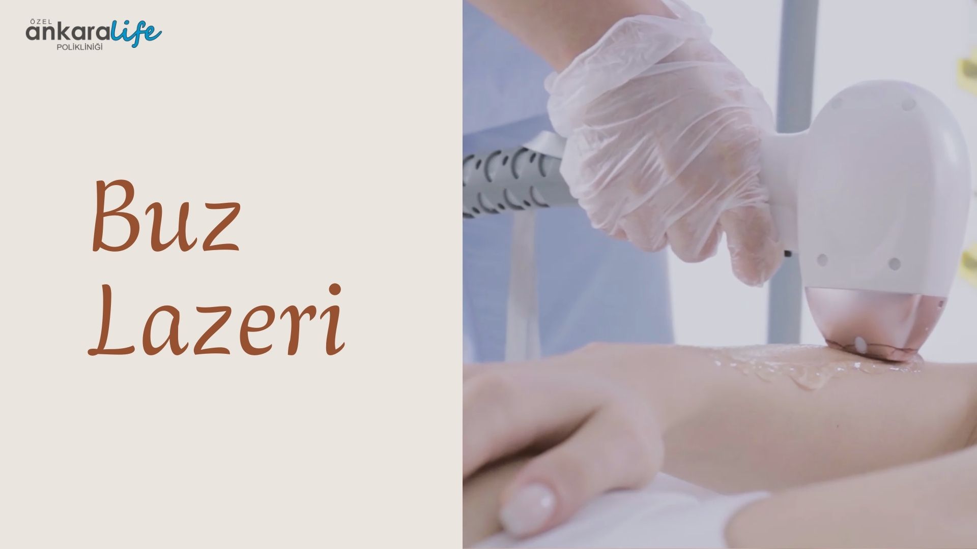 buz-lazeri