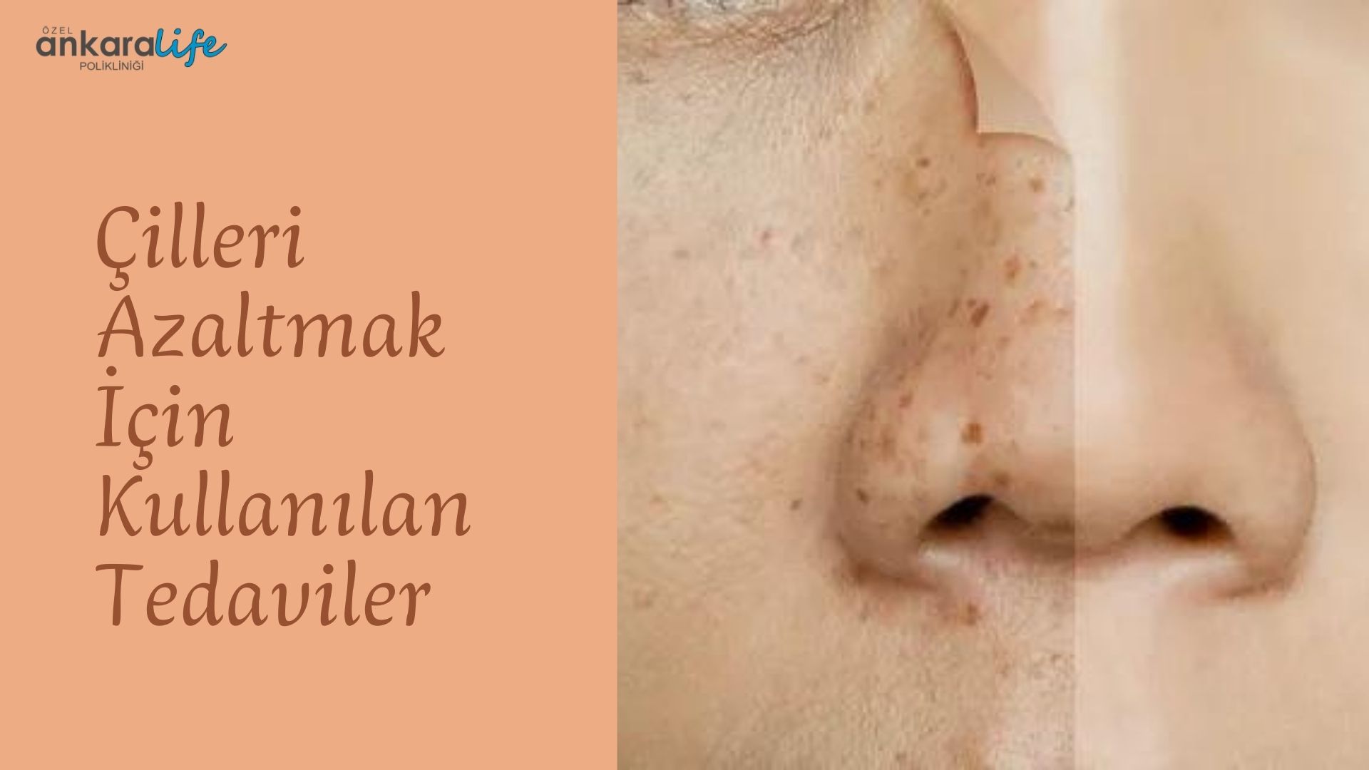 cilleri-azaltmak