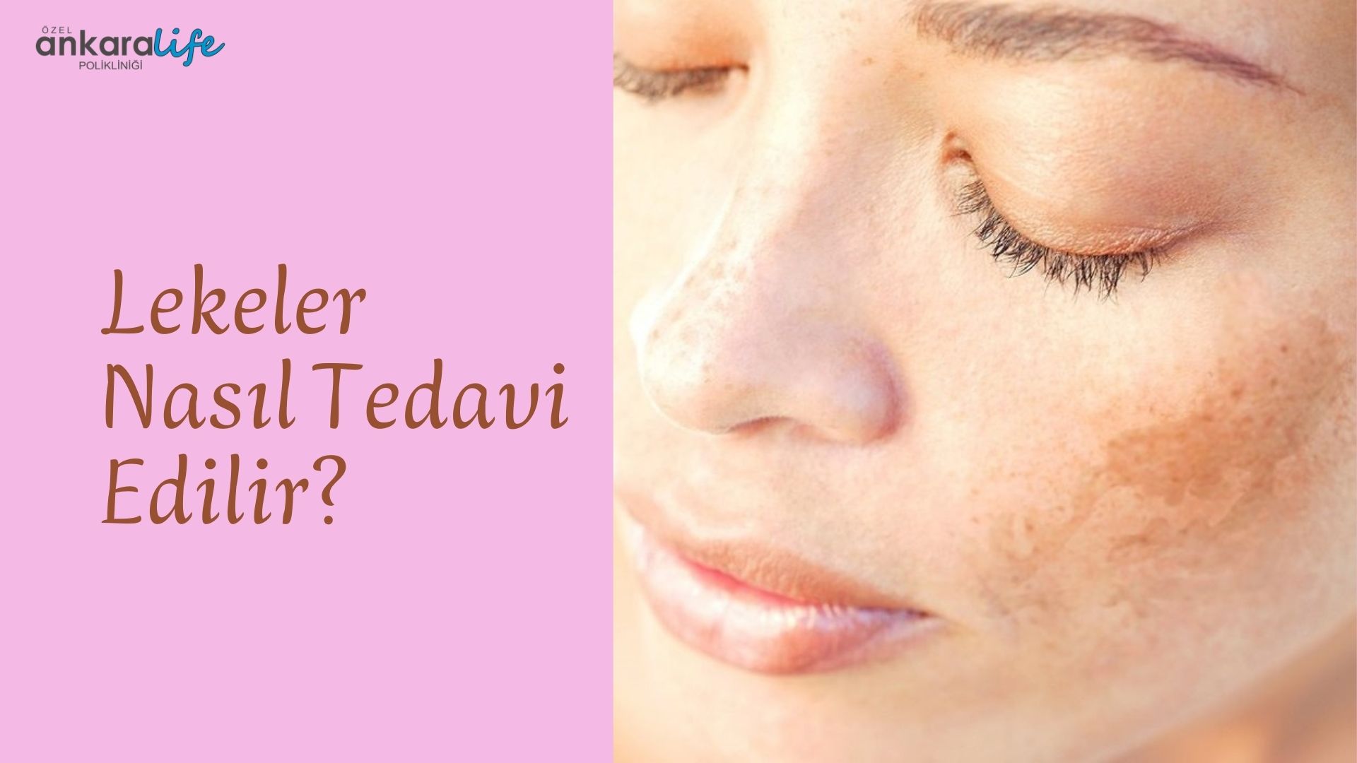 lekeler-nasil-tedavi-edilir