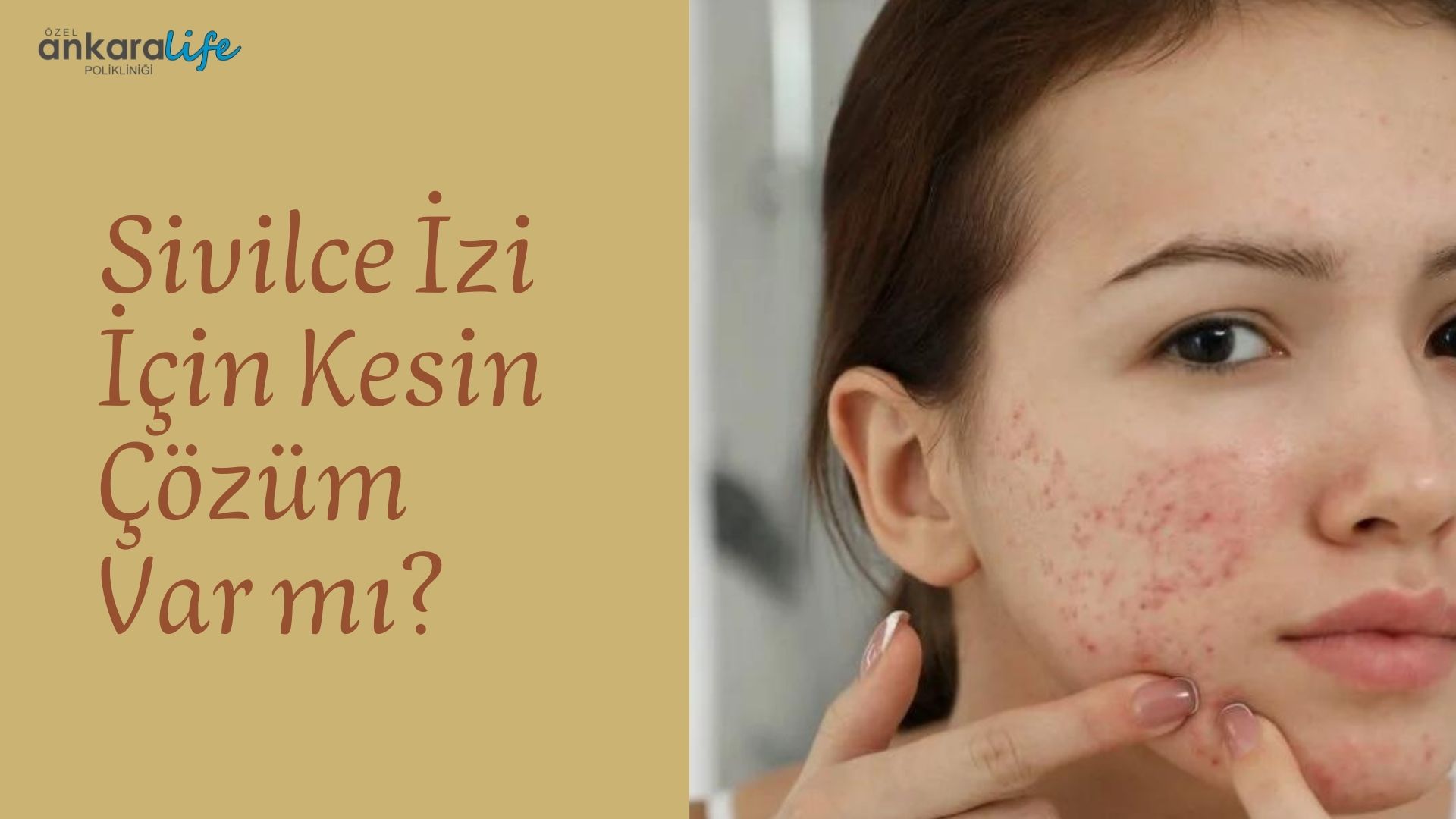Sivilce İzi İçin Kesin Çözüm Var Mı
