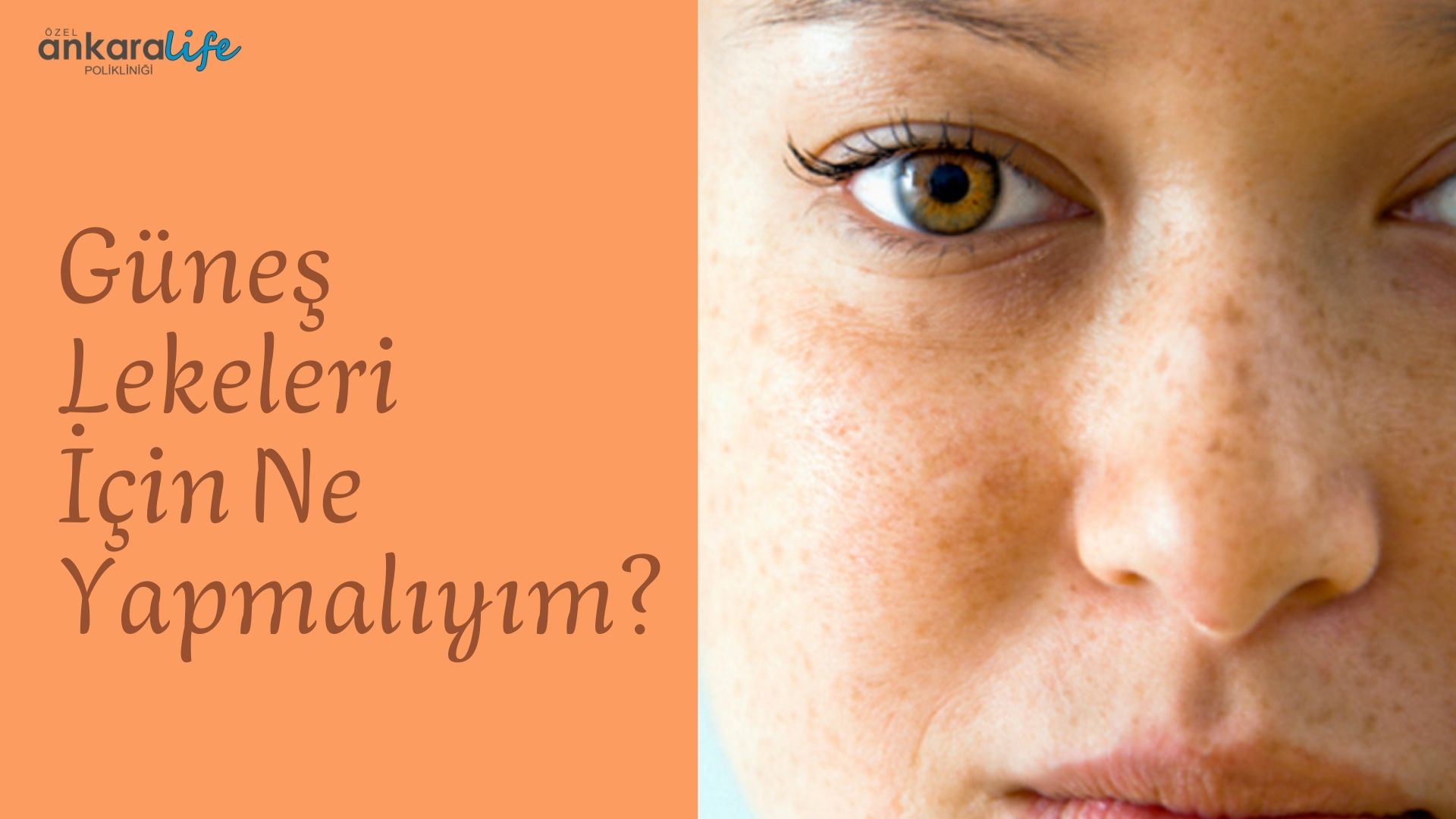 Güneş Lekeleri İçin Ne Yapmalıyım