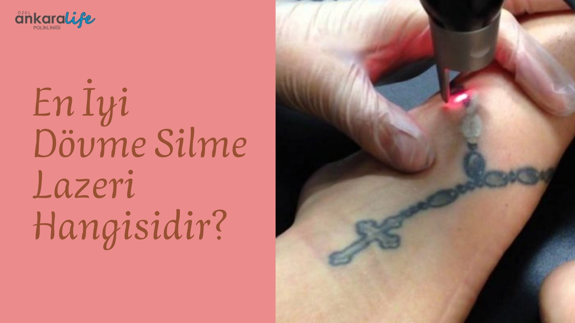en-iyi-dovme-silme lazeri