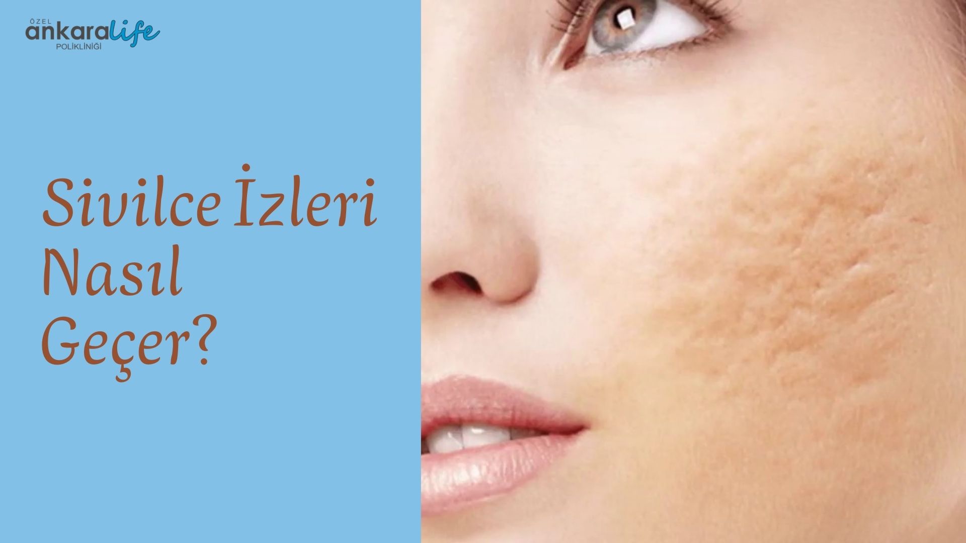sivilce-izleri