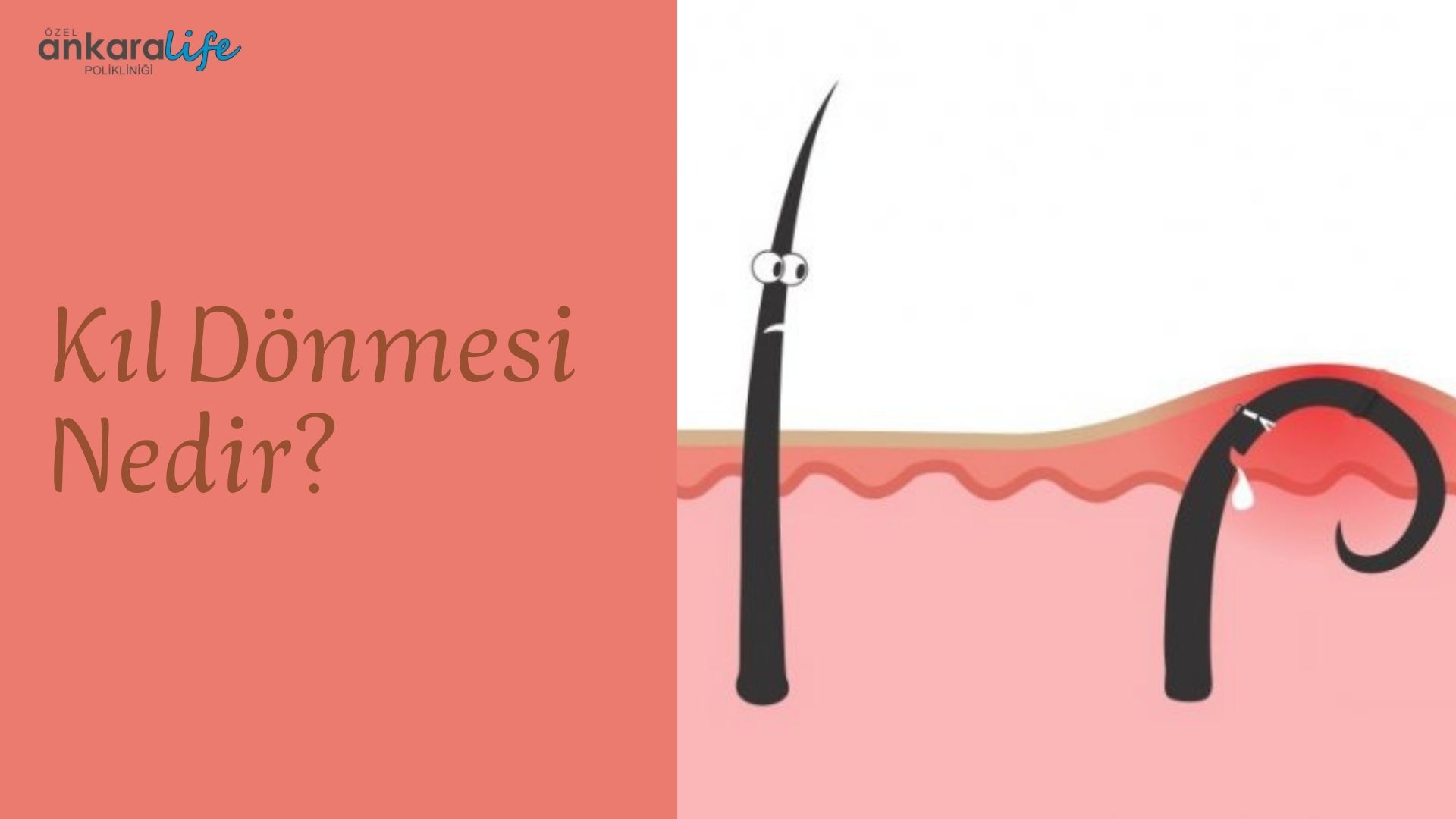 Kıl Dönmesi Nedir