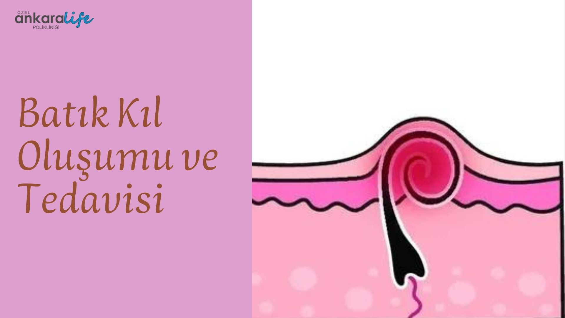 Batık Kıl Oluşumu ve Tedavisi