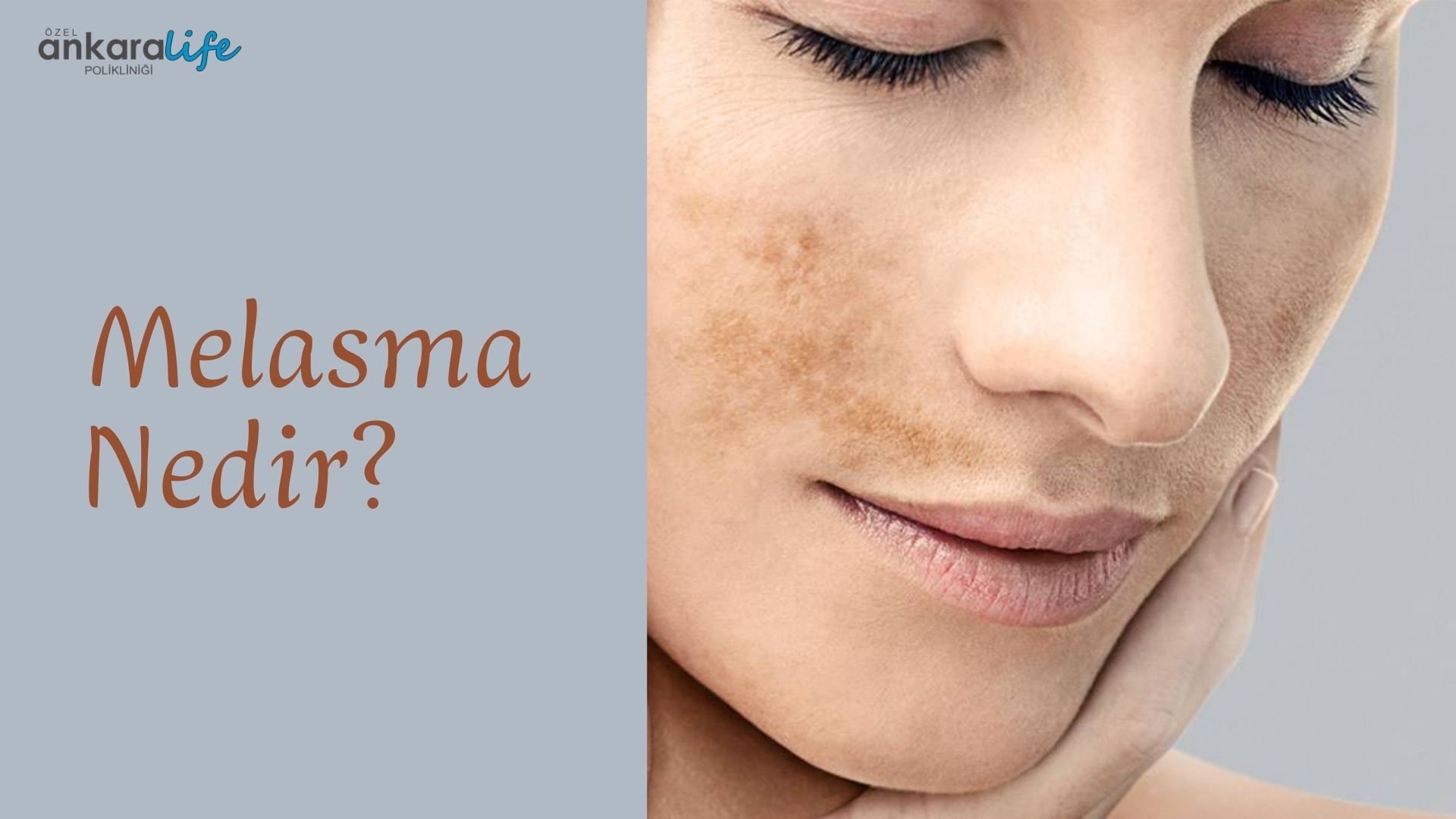 Melasma Nedir