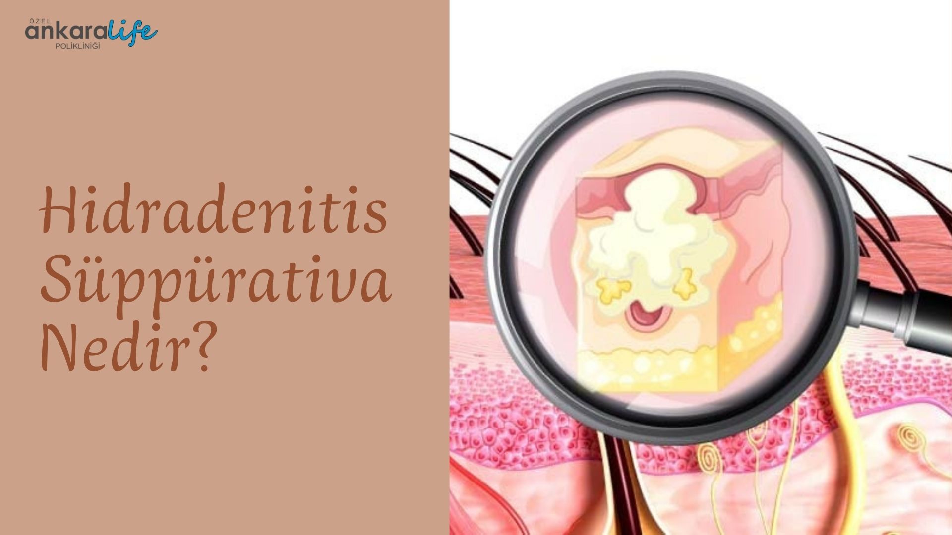 Hidradenitis Süppürativa Nedir