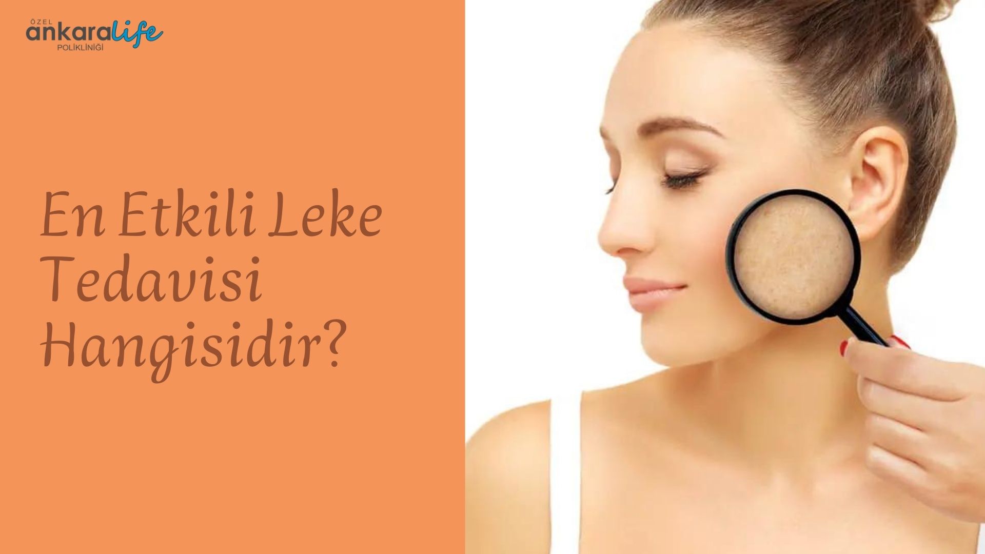 En Etkili Leke Tedavisi Hangisidir