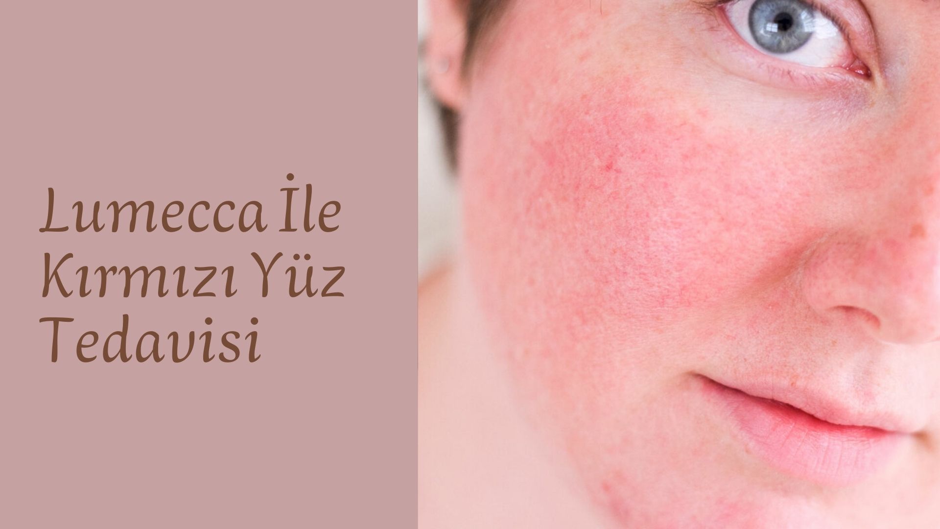 lumecca-ıpl-nedir