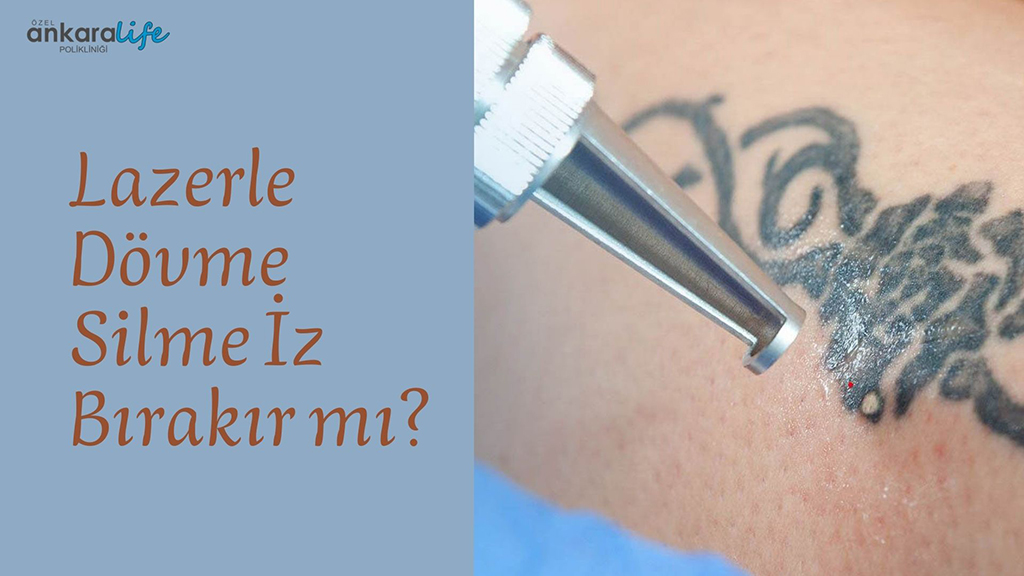 Lazerle Dövme Silme İz Bırakır Mı