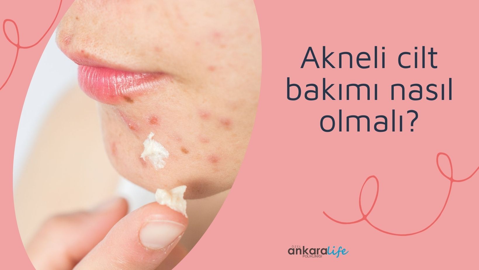akneli-cilt-bakimi-nasil-olmalidir