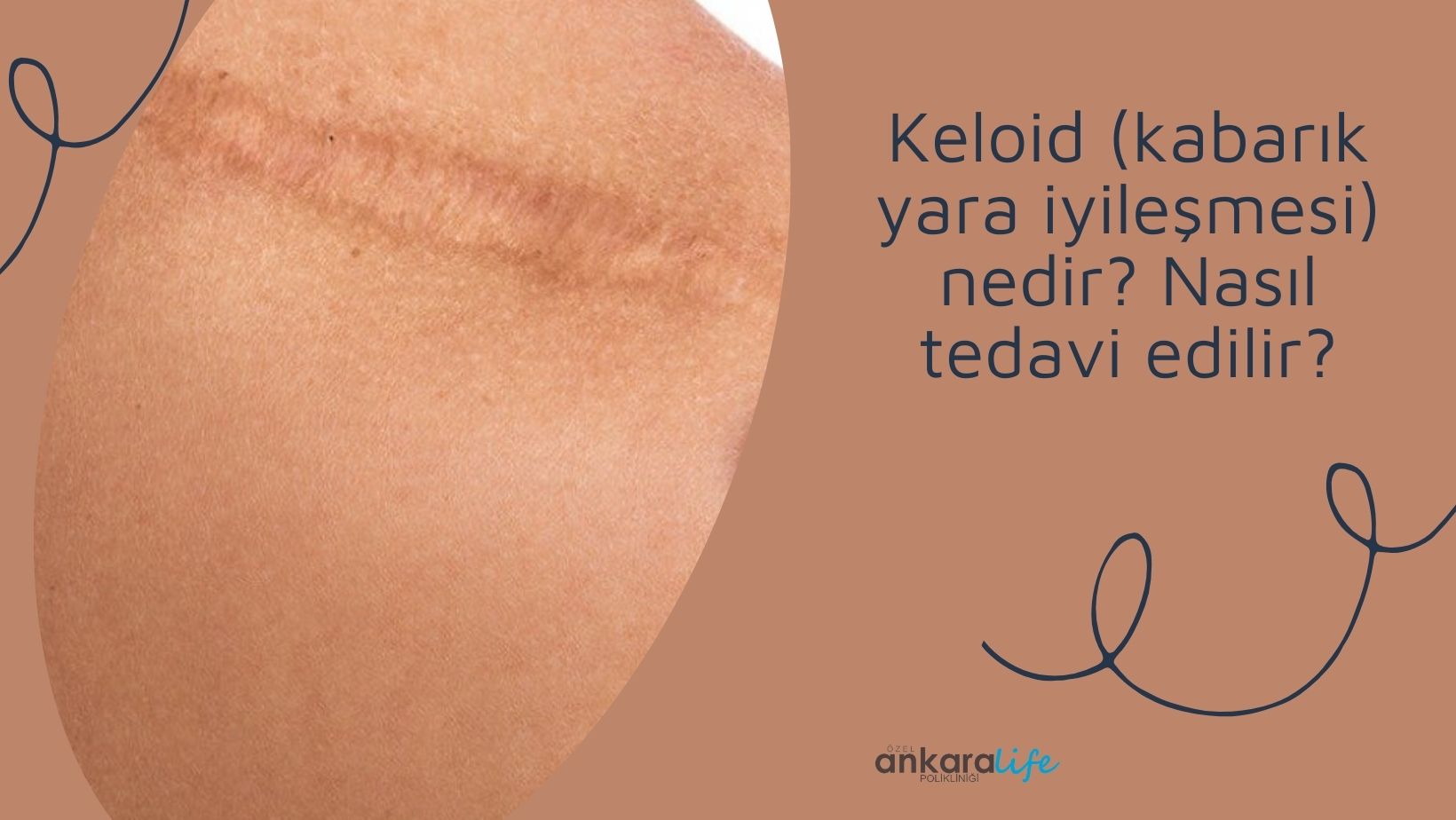 keloid-kabarık yara iyileşmesi-nedir-nasil-tedavi-edilir