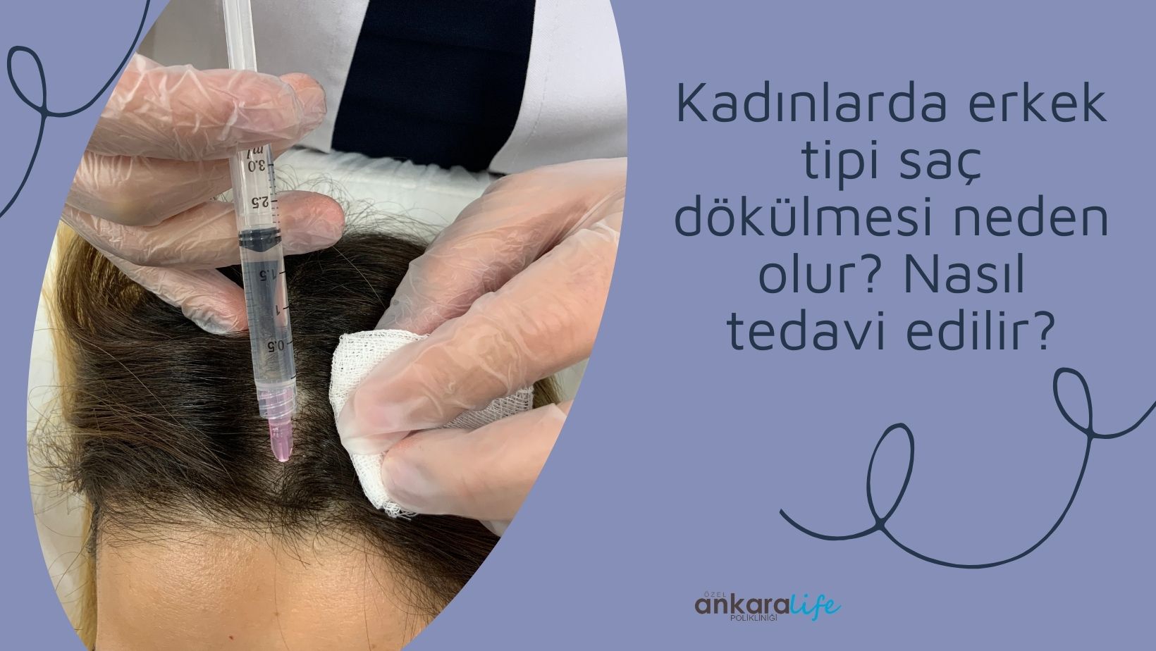 kadınlarda-erkek-tipi-sac-dokulmesi-neden-olur-nasil-tedavi-edilir