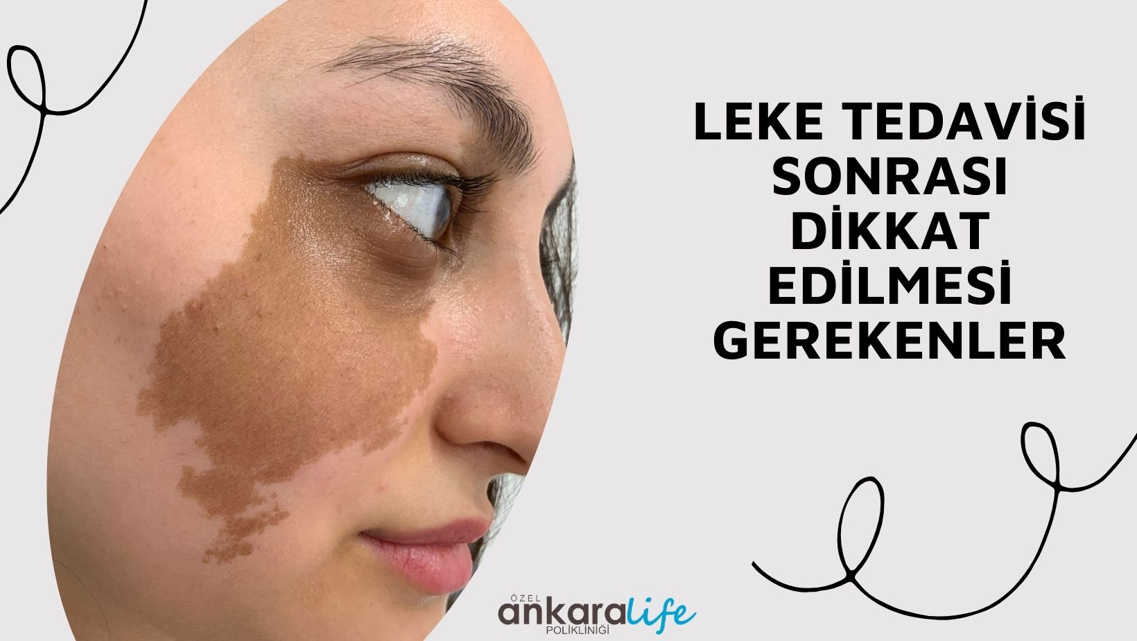 leke-tedavisinden-sonra-dikkat-edilmesi-gerekenler