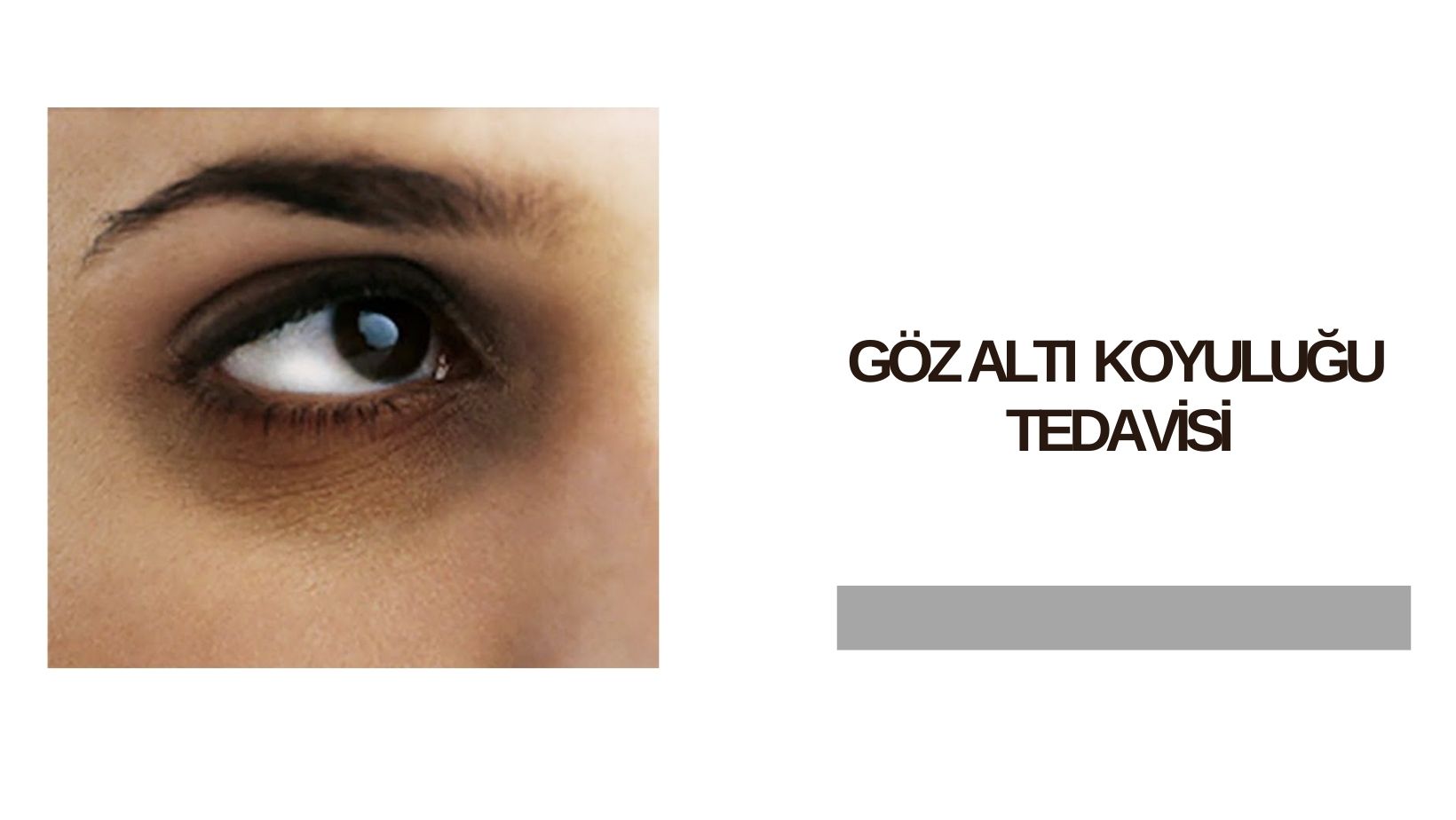 gozalti-koyulugu-tedavisi