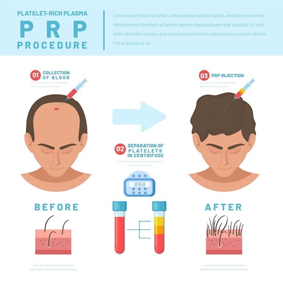 prp-nedir