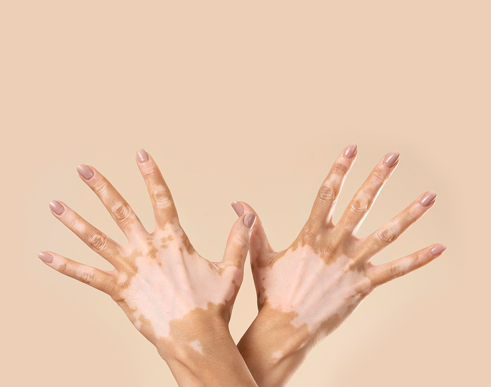 vitiligo-nedir