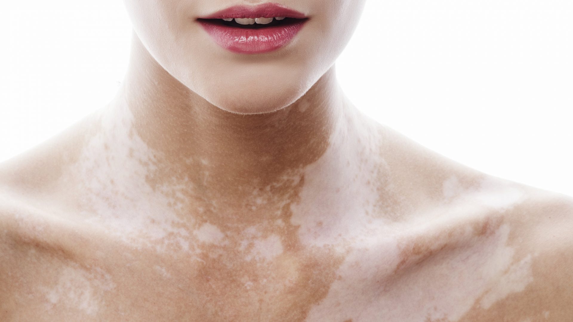 her-beyaz-leke-vitiligo-degildir