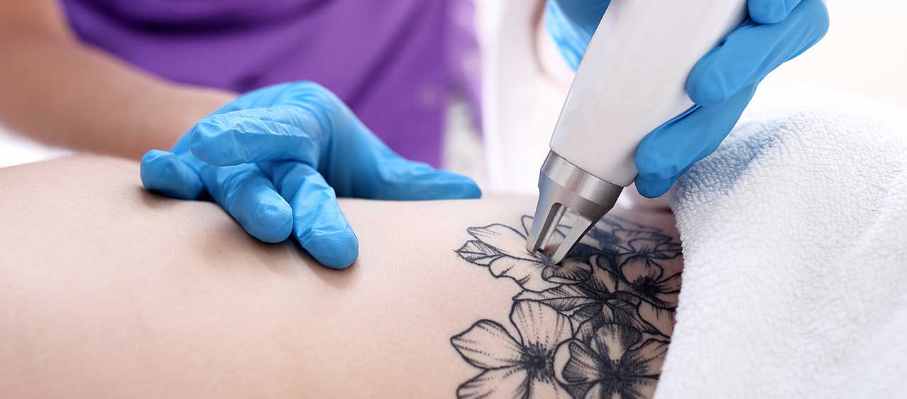 -dovme-silme-cihazi