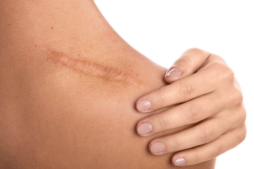 keloid-nasil-gecer