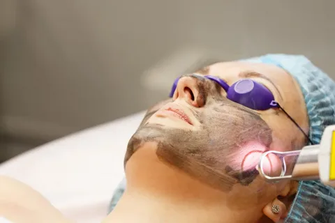 lazer-peeling