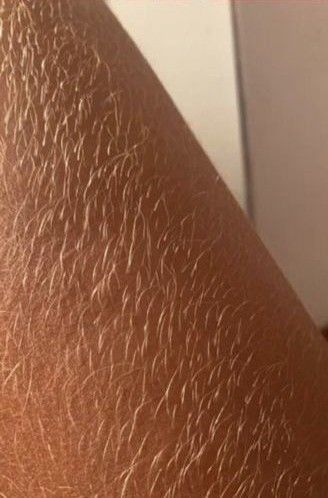 lazer-sari-tuyleri-gorur-mu