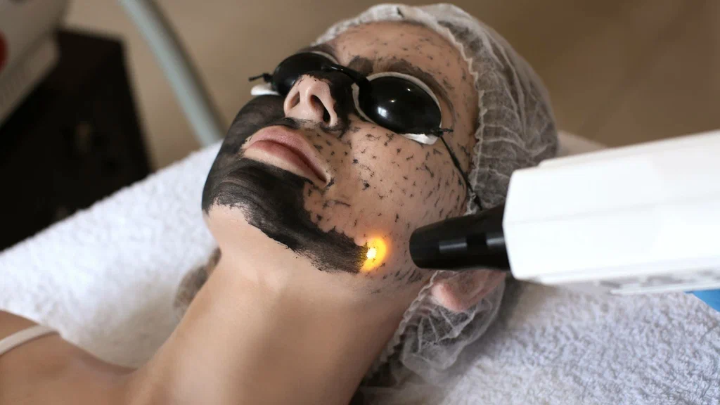 lazerle-karbon-peeling-yaptiranlar