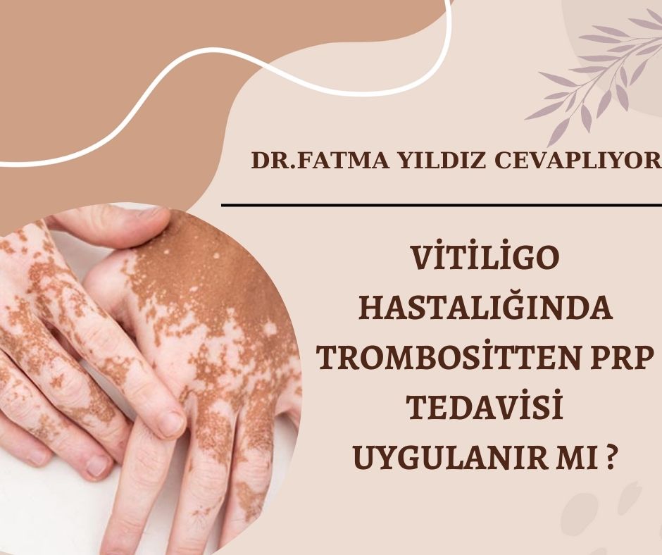 Vitiligo /Hastalığında/ Trambositten PRP /Tedavisi /Uygulanır mı?
