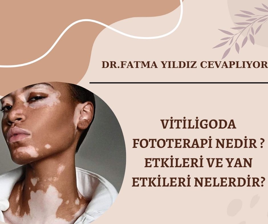Vitiligoda fototerapi-nedir-?-Etkileri-ve-yan-etkileri-nelerdir?