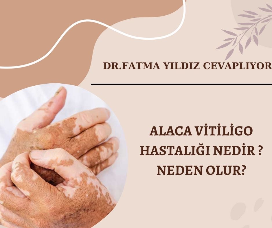 Alaca-vitiligo-hastalığı-nedir ? Neden-olur?