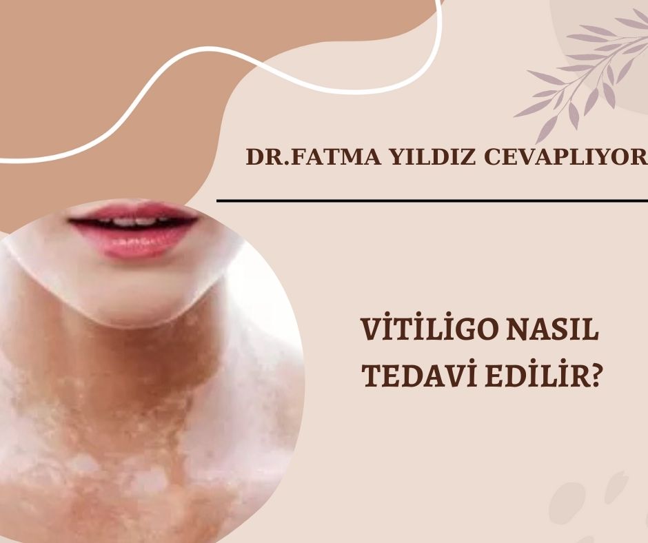 Vitiligo-nasıl-tedavi-edilir?