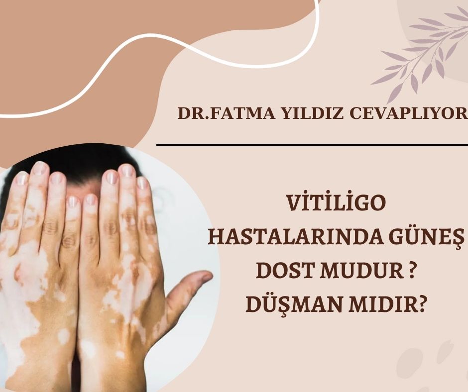 Vitiligo/ Hastalarında /Güneş /Dost/ Mudur ? Düşman /Mıdır ?