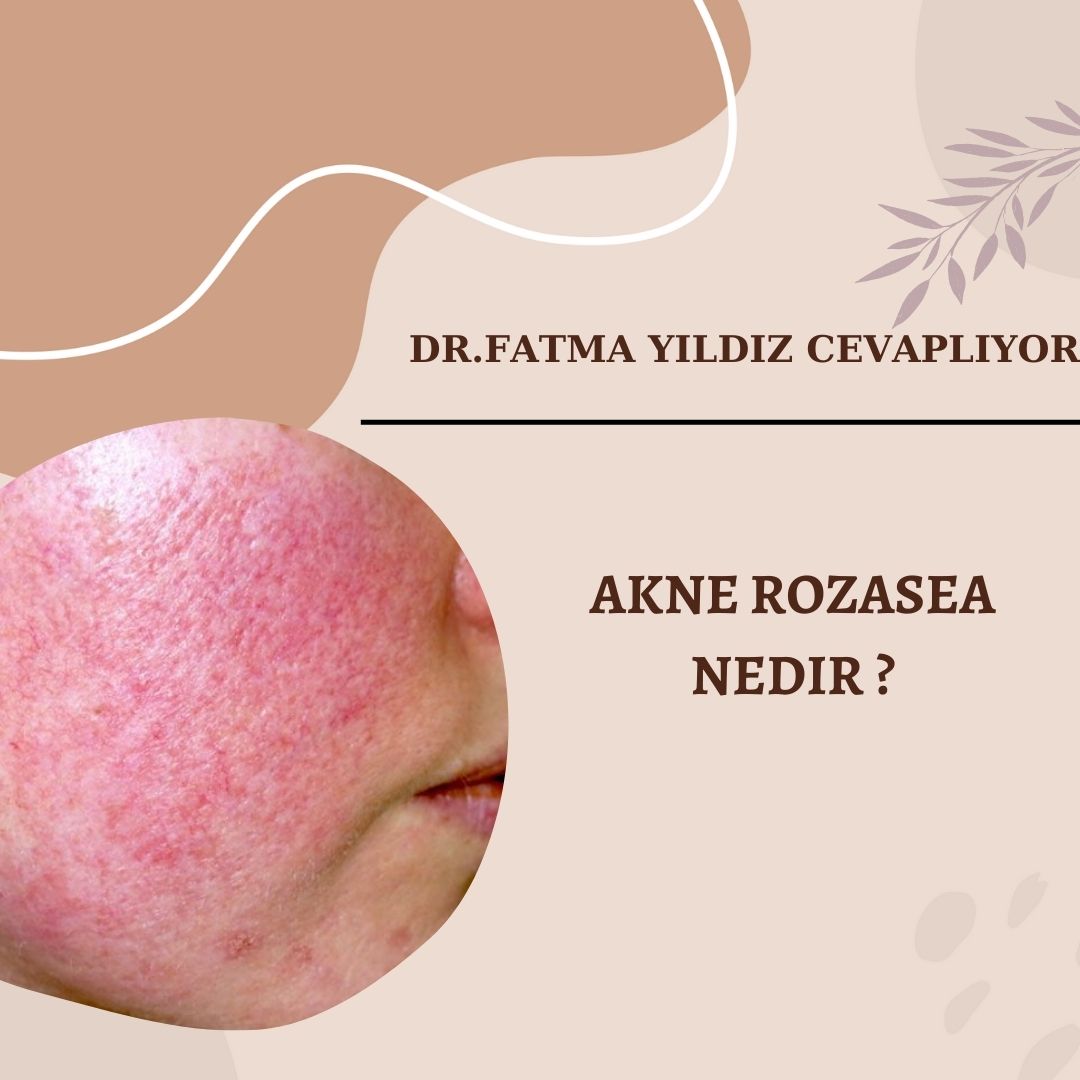akne-rozasea-nedir