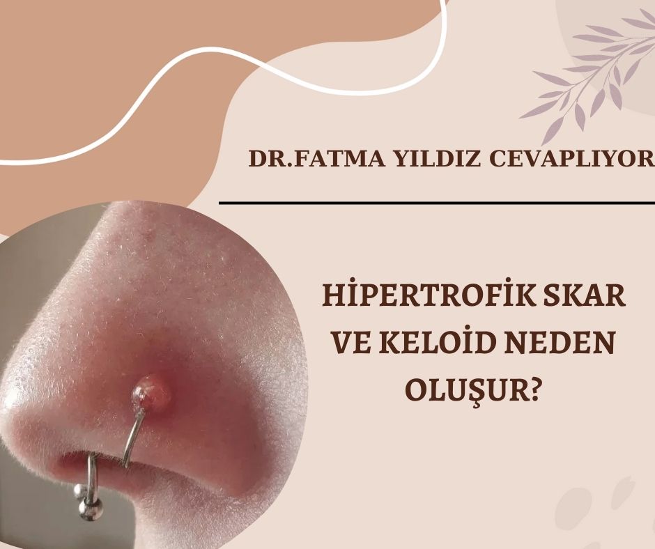 keloid