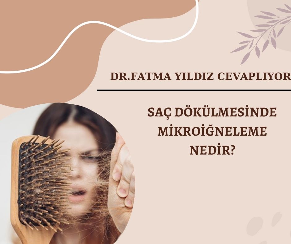 Saç/ Dökülmesinde/ Mikroiğneleme/ Nedir ?