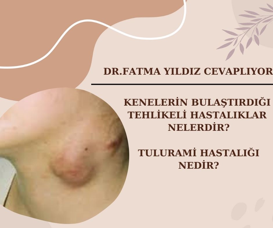 Kenelerin/ Bulaştırdığı/ Tehlikeli/ Hastalıklar/ Tulurami/ Hastalığı /Nedir? 