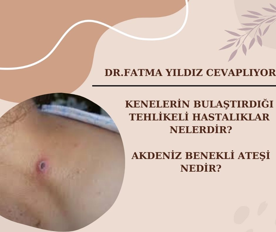 Akdeniz/ Benekli/ Ateşi/ Nedir? Nasıl/ Korunabilirsiniz?