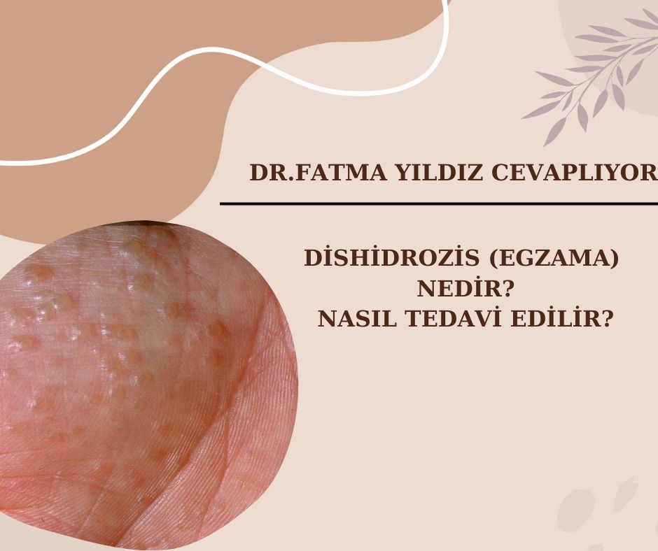 Dishidrozis/ Nedir? Nasıl/ Tedavi/ Edilir? 